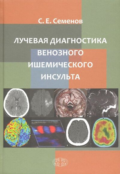 Книга: Лучевая диагностика венозного ишемического инсульта (Семенов Станислав Евгеньевич) ; Фолиант (мед.), 2018 