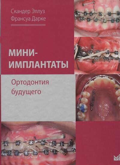 Книга: Мини-имплантаты Ортодонтия будущего (Эллуз Скандер) ; МЕДпресс-информ, 2020 
