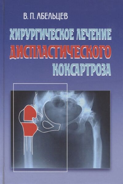Книга: Хирургическое лечение диспластического коксартроза (Абельцев Владимир Петрович) ; Медицина, 2008 
