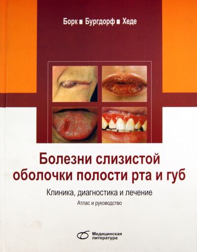 Книга: Болезни слизистой оболочки полости рта и губ. Клиника, диагностика и лечение (Борк Конрад, Бургдорф Вальтер, Хеде Николаус) ; Медицинская литература, 2020 