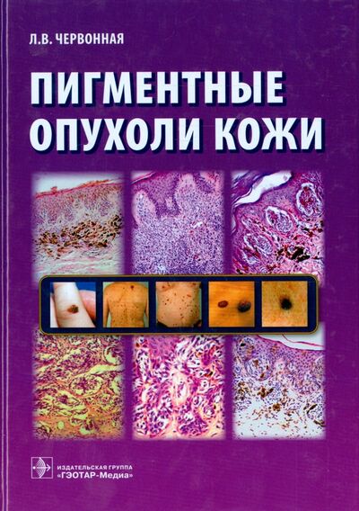Книга: Пигментные опухоли кожи (Червонная Лариса Владимировна) ; ГЭОТАР-Медиа, 2016 